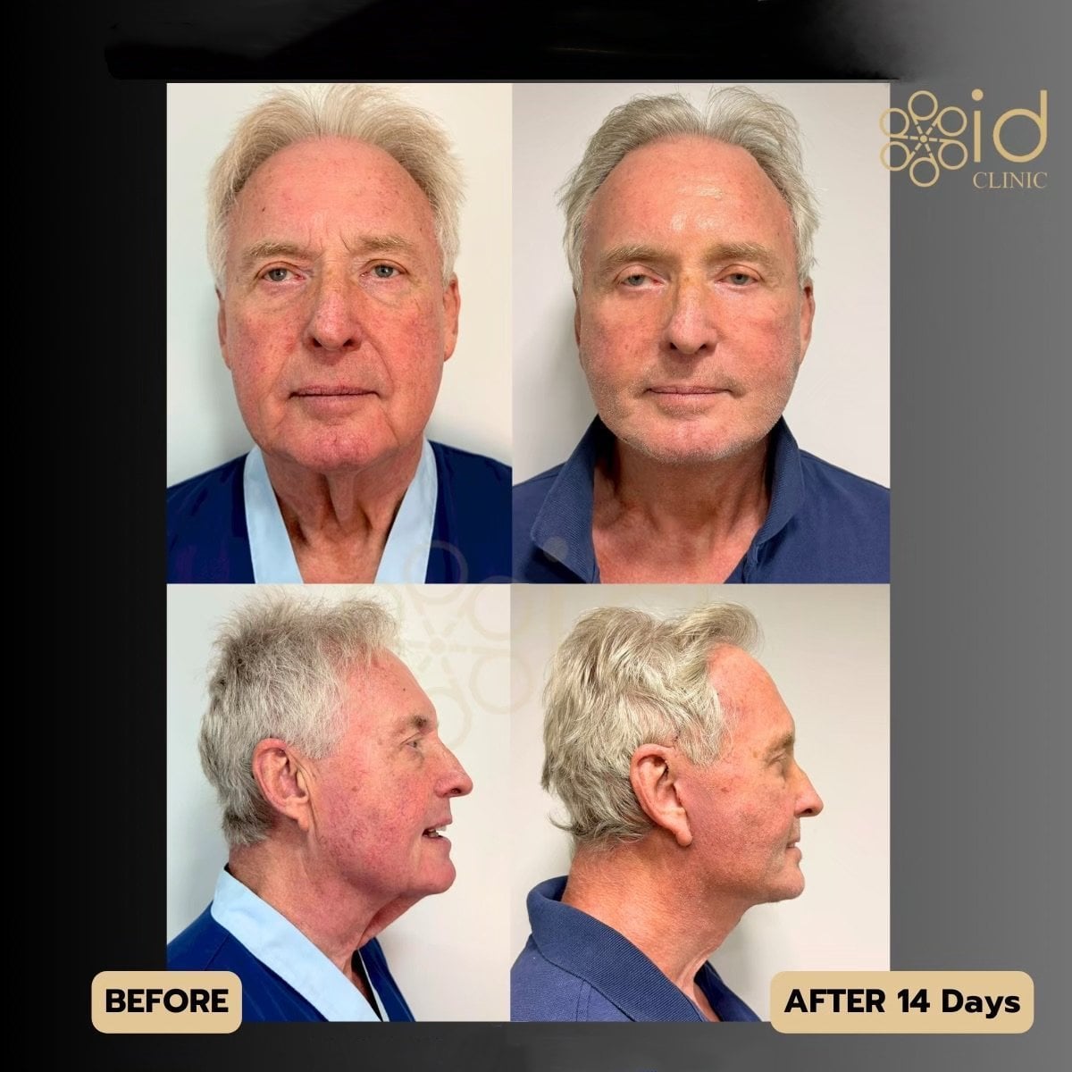 Resultados antes y después de deep plane facelift en ID Clinic Bangkok, rejuvenecimiento facial