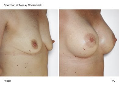 Before and after breast augmentation at Klinika Promedion, visible volume enhancement result