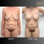 Before and after tummy tuck results at ID Clinic Bangkok, visible abdominal contour improvement