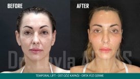 Before and after deep plane facelift results at Quartz Hospital, visible facial rejuvenation