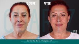 Before and after deep plane facelift results at Quartz Hospital, visible facial rejuvenation