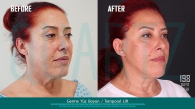 Before and after deep plane facelift results at Quartz Hospital, visible facial rejuvenation