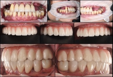 before-after photo all-on-4-dental-implants