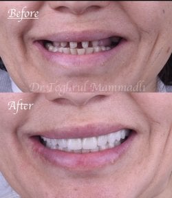 Before and after dental implant results at Dentaland Premium Luxury Clinic & Academy, restored smile