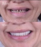 Before and after dental implant results at Dentaland Premium Luxury Clinic & Academy, restored smile