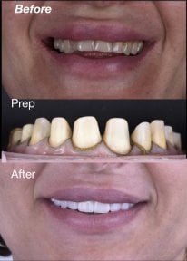 Before and after dental veneers at Dentaland Premium Luxury Clinic & Academy, smile makeover result