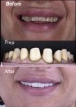 Before and after dental veneers at Dentaland Premium Luxury Clinic & Academy, smile makeover result