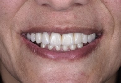 Результат дентального імпланта в Dentaland Premium Luxury Clinic & Academy, відновлена посмішка