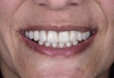 Результат дентального імпланта в Dentaland Premium Luxury Clinic & Academy, відновлена посмішка