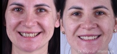 Before and after dental implant results at Dentaland Premium Luxury Clinic & Academy, improved smile
