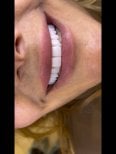 Dental implant result at Dentaland Premium Luxury Clinic & Academy – natural smile restoration