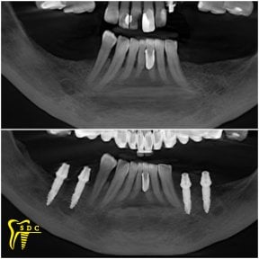 before-after photo implantacia-zuba