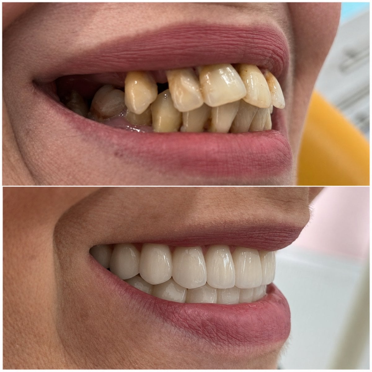 Antes y después de coronas de zirconia en Spanderashvili Dental Clinic, resultado de sonrisa