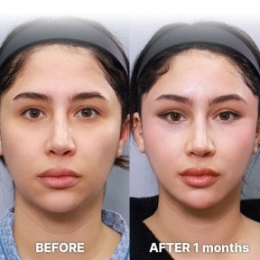 before-after photo blepharoplasty-eyelid