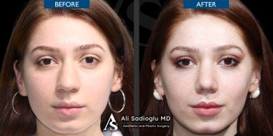 before-after photo rhinoplasty-nose-job