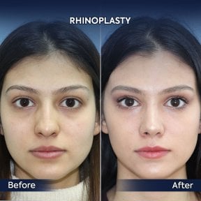 before-after photo rhinoplasty-nose-job