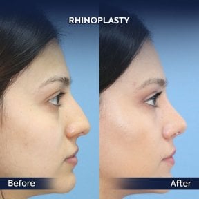 before-after photo rhinoplasty-nose-job