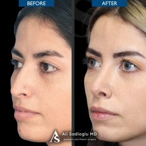 before-after photo rhinoplasty-nose-job