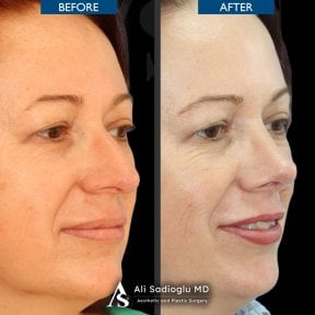 before-after photo rhinoplasty-nose-job