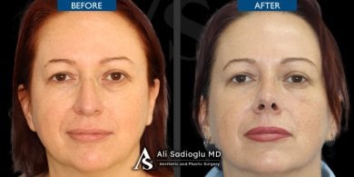 before-after photo rhinoplasty-nose-job