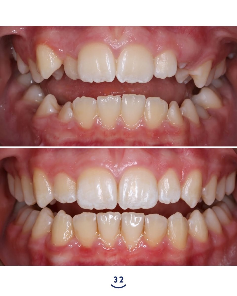 Resultados antes y después de Invisalign: dientes más rectos y sonrisa alineada