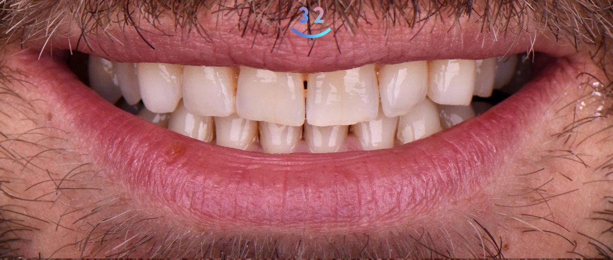 Transformación de sonrisa tras carillas dentales en Clínica 32, resultado natural