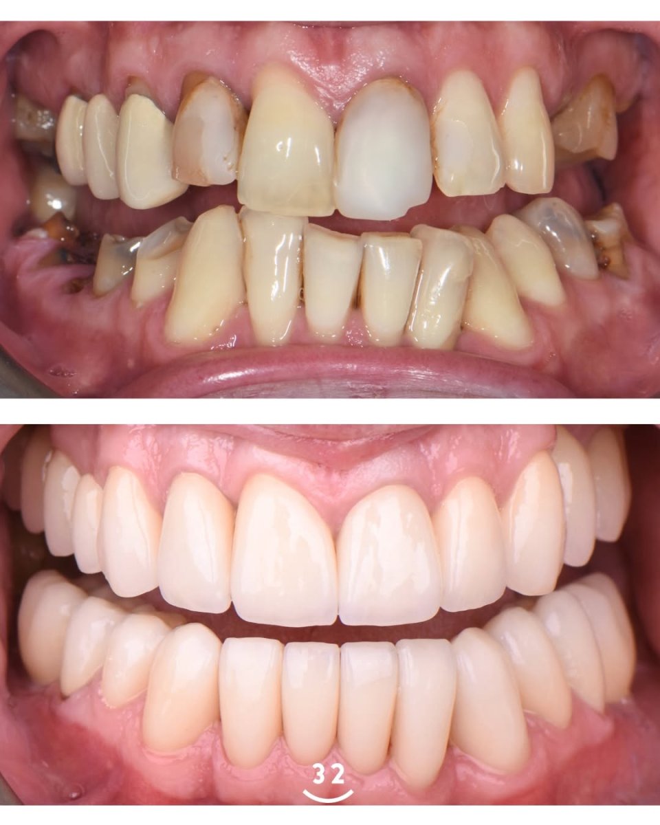 نتائج قبل وبعد تجميل الابتسامة – قشور الأسنان لتحول الأسنان إلى بيضاء ومتساوية