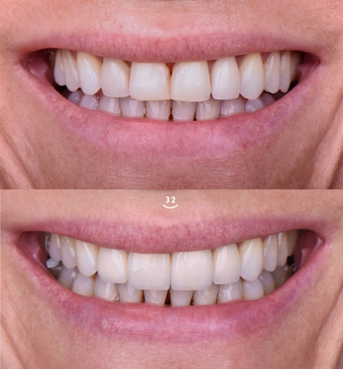 Resultados de blanqueamiento dental antes y después: sonrisa visiblemente más brillante