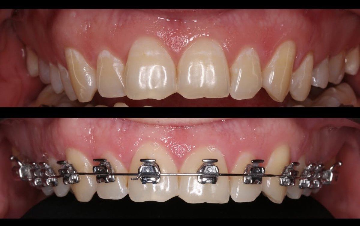 Resultados antes y después del tratamiento con brackets – mejora en la alineación dental