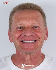 before-after photo zirconia-all-on-4-dental-implants