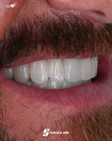 before-after photo zirconia-all-on-4-dental-implants