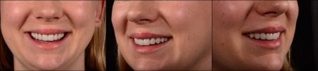 Smile transformation with dental veneers at RIKOTA Dental Clinic, natural-looking result