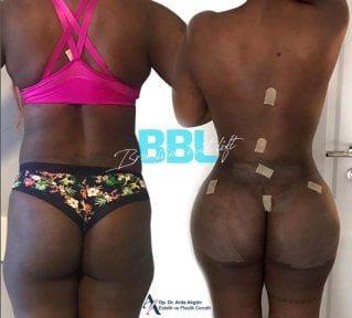 before-after photo abdominoplasty