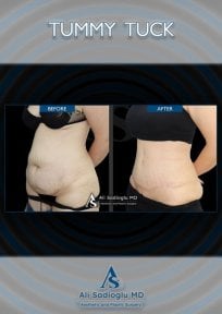 before-after photo abdominoplasty