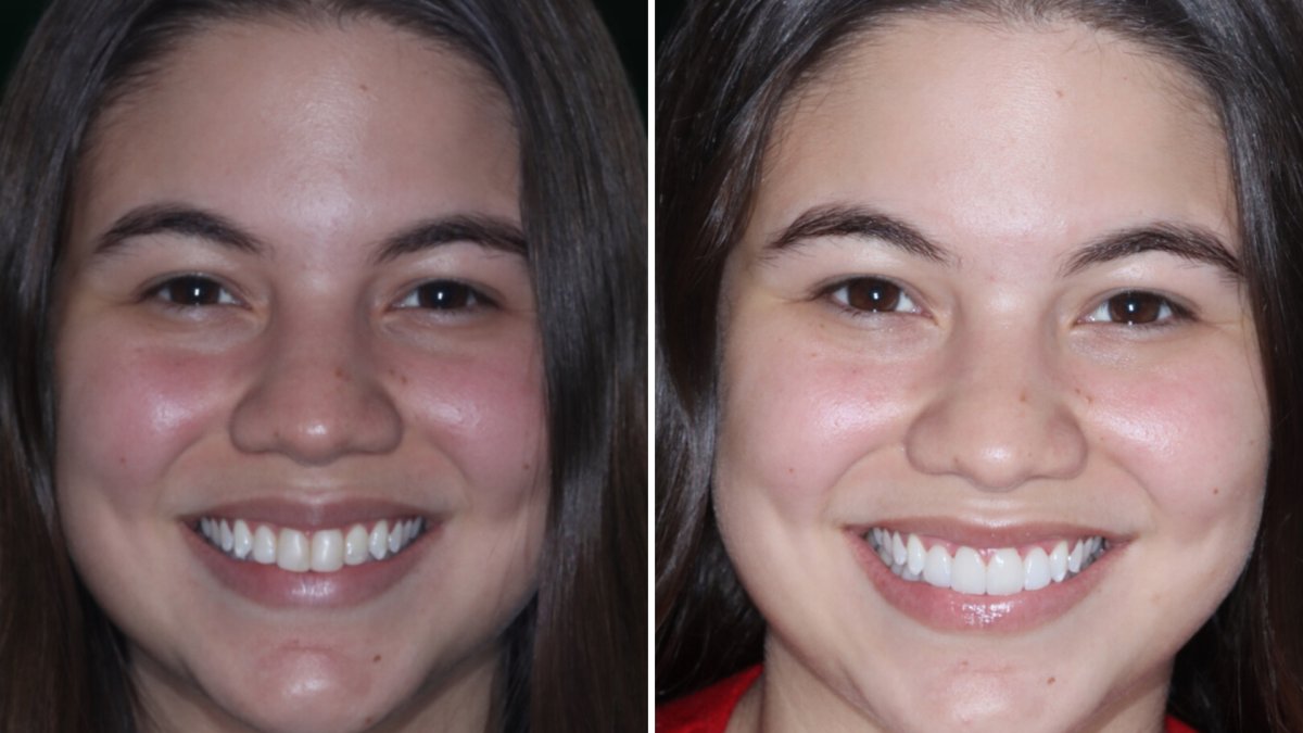 Resultados antes y después de Hollywood Smile: carillas dentales para dientes más blancos