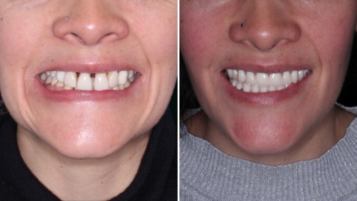 Resultados antes y después de Hollywood Smile: carillas dentales para dientes blancos y parejos