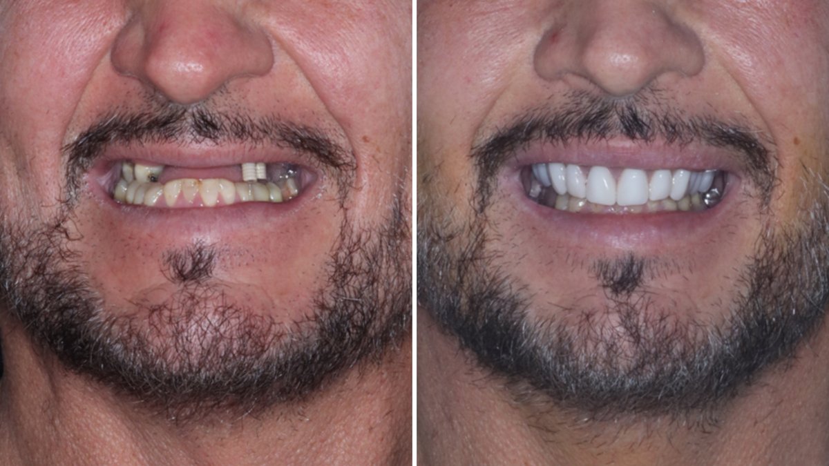 Resultados antes y después de Hollywood Smile: implantes y carillas para sonrisa perfecta