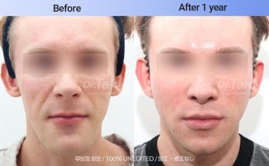 before-after photo tightening-of-facial-skin-facelift