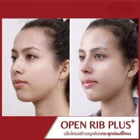 Resultados de rinoplastia antes y después en DGB Clinic, mejora de la forma nasal y perfil facial