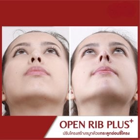 Resultado de rinoplastia antes y después en DGB Clinic, mejora de forma y simetría nasal