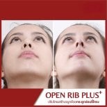 Resultado de rinoplastia antes y después en DGB Clinic, mejora de forma y simetría nasal