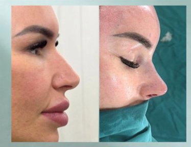Resultados de rinoplastia antes y después en DGB Clinic, perfil nasal natural