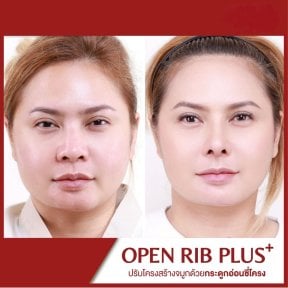 Resultado de rinoplastia antes y después en DGB Clinic, remodelación nasal Open Rib Plus
