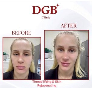 Before and after thread lifting and skin rejuvenation results at DGB Clinic, facial lift effect