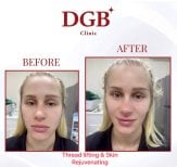 Before and after thread lifting and skin rejuvenation results at DGB Clinic, facial lift effect