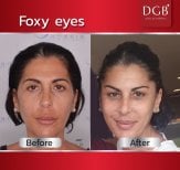 Before and after foxy eyes procedure at DGB Clinic, lifted eye contour result