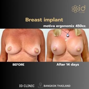 До та після збільшення грудей Motiva 450cc в ID Clinic Bangkok, результат за 14 днів