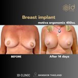 До та після збільшення грудей Motiva 450cc в ID Clinic Bangkok, результат за 14 днів