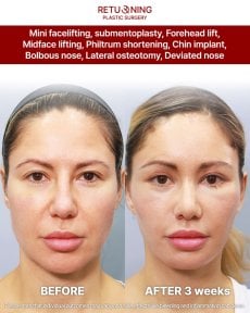 Before and after results of combined facial procedures at Returning Plastic Surgery, 3 weeks post-op