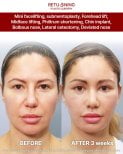 Before and after results of combined facial procedures at Returning Plastic Surgery, 3 weeks post-op